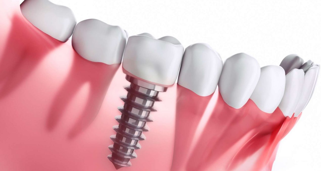 Comment se déroule la pose d’un implant dentaire ?